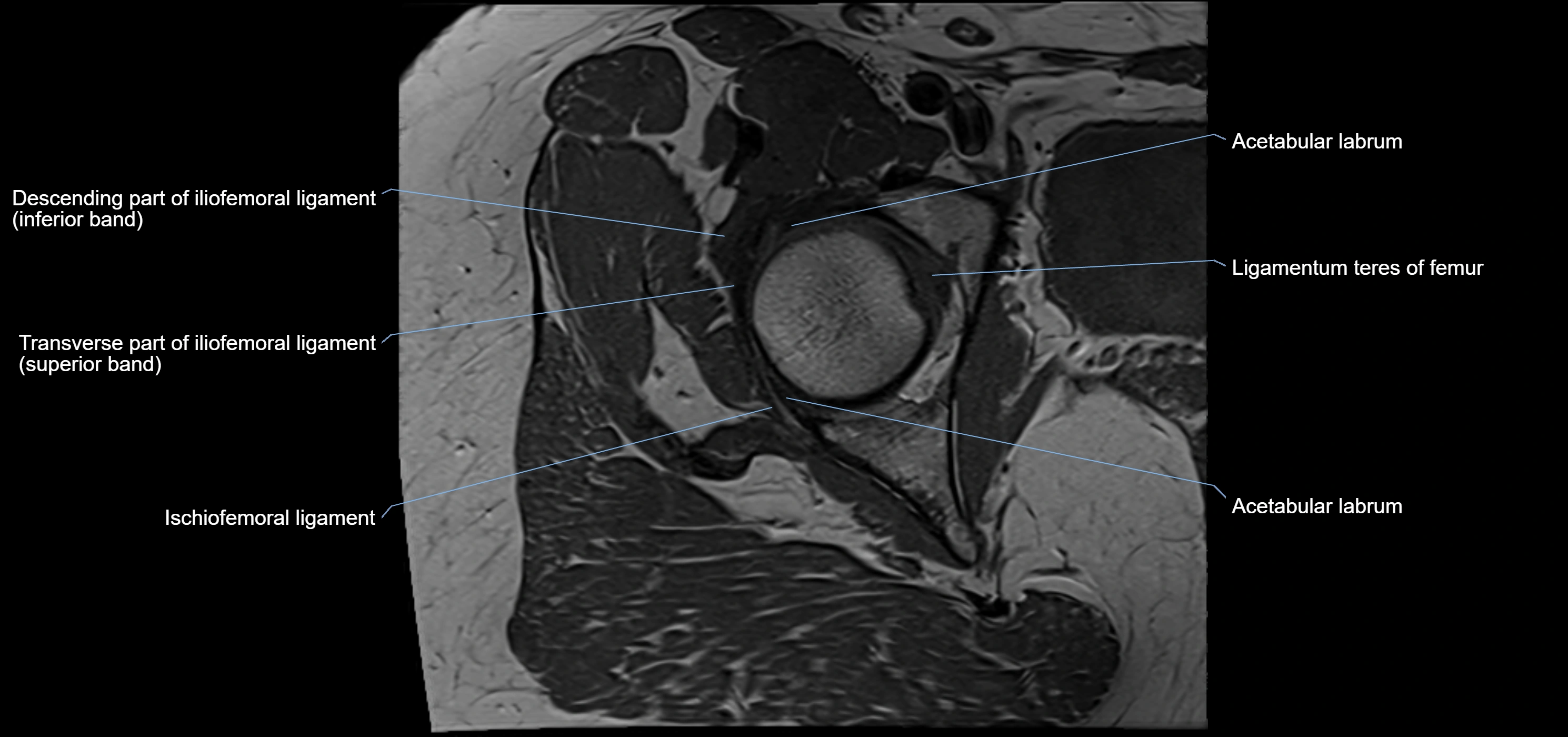Hip ligament anatomy axial 3T MRI image -img-13001-00013.webp